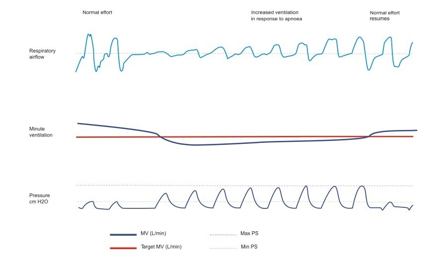 minute-ventilation-aircurve10cs-pacewave-resmed